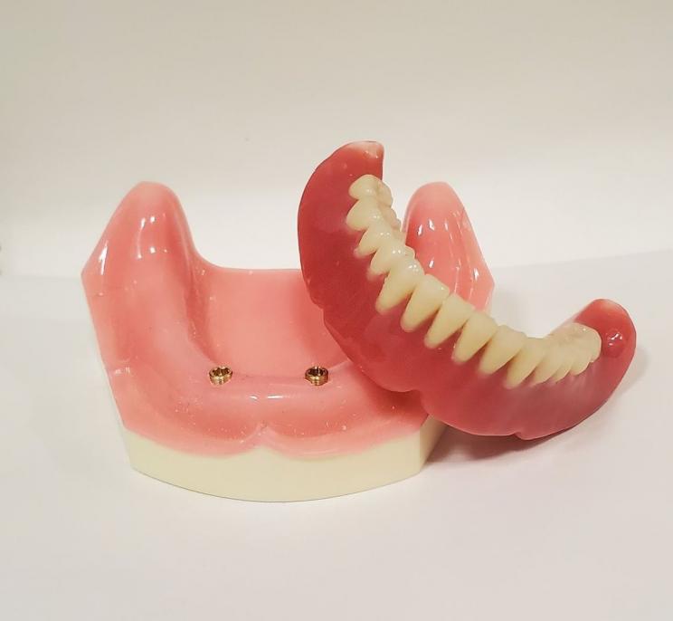 入れ歯でお困りの方。インプラントオーバーデンチャーをご存知ですか？