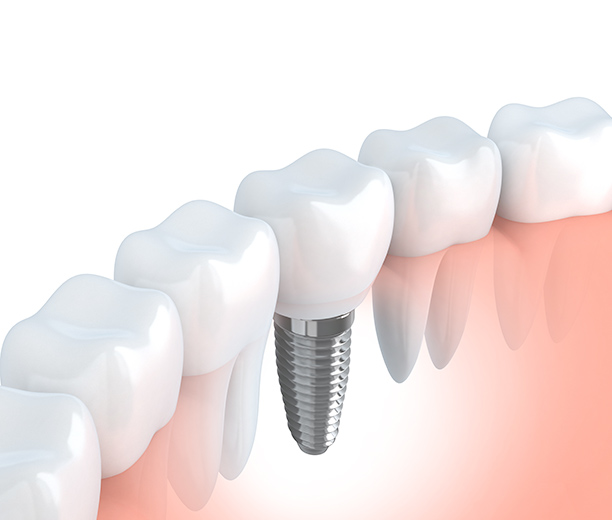 インプラント治療後のメンテナンス