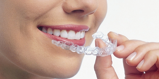 マウスピース矯正